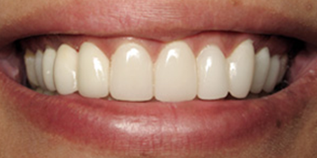 Periodontics of the Desert