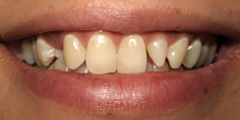 Periodontics of the Desert