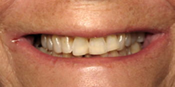 Periodontics of the Desert