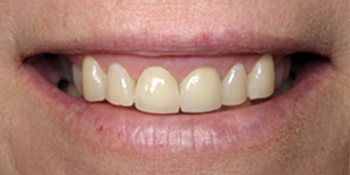 Periodontics of the Desert