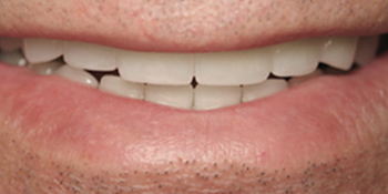 Periodontics of the Desert