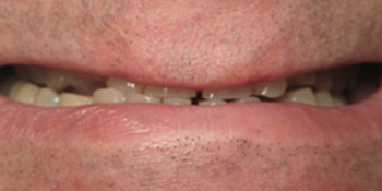 Periodontics of the Desert