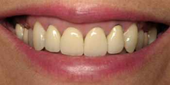 Periodontics of the Desert