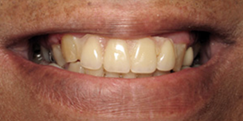 Periodontics of the Desert