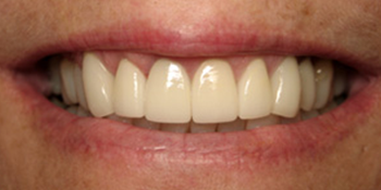 Periodontics of the Desert