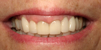 Periodontics of the Desert