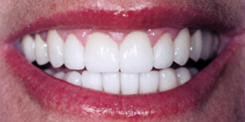 Periodontics of the Desert