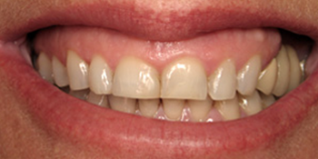 Periodontics of the Desert