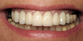 Periodontics of the Desert