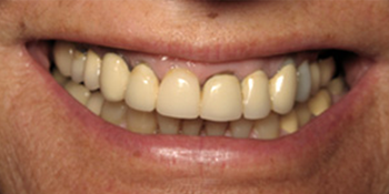 Periodontics of the Desert