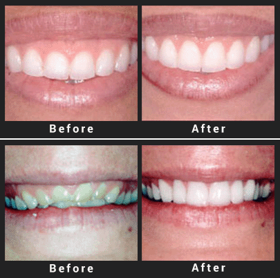 Esthetic Crown Lengthening