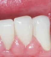 New Crowns Secure in Place