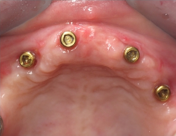 View of locator abutments in place with