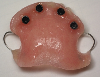 View of the inside of the over-denture with