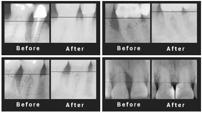 Advanced-periodontal-disease-causes
