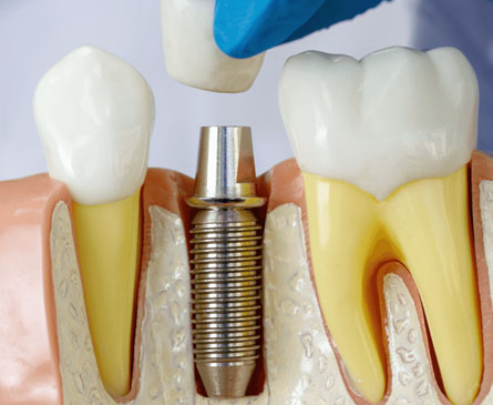 If-you-are-missing-teeth-dental-implants