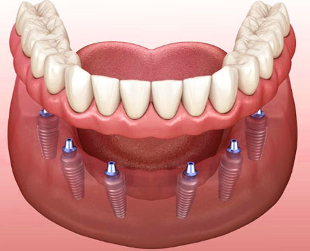 Implants-for-Dentures