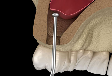 Missing-teeth-and-periodontal-disease