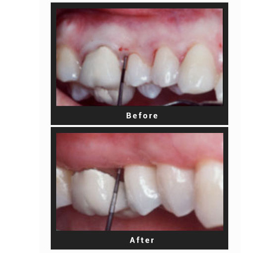 Osseous-surgery-is-a-procedure