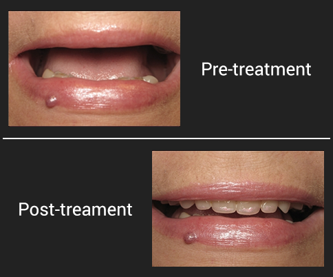 img-Pre-treatment and Post-treament