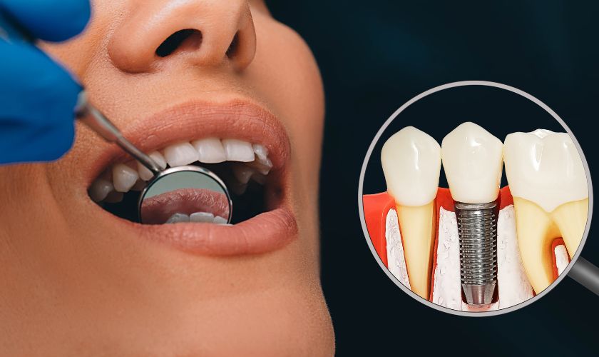 Featured image for “Are Dental Implants Right for You? Unveiling the Benefits and Considerations”