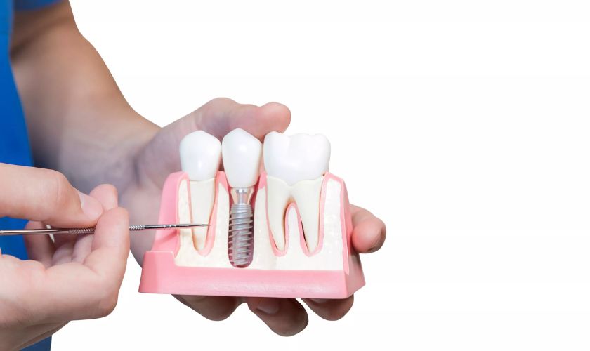 Featured image for “Essential Steps for Successful Dental Implants Palm Desert”