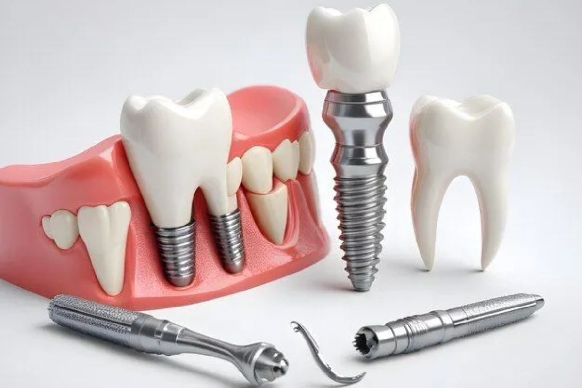 Featured image for “Missing Teeth? Here’s Why Palm Desert Residents Prefer Implants”