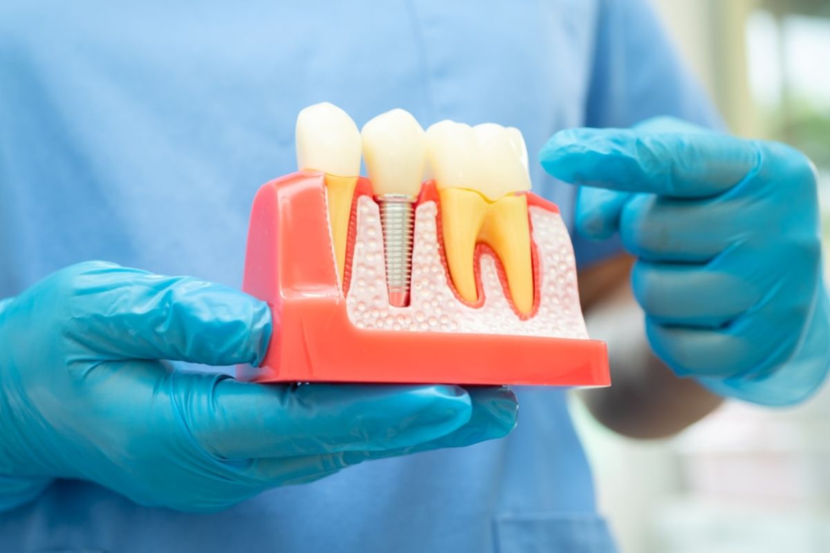 Featured image for “How To Care For Your Dental Implants: Tips For Long-Term Success”