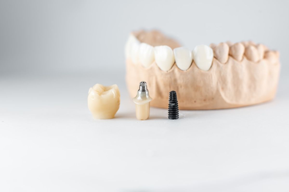 Featured image for “How Long Do Mini Dental Implants Last? Durability & Care Tips”