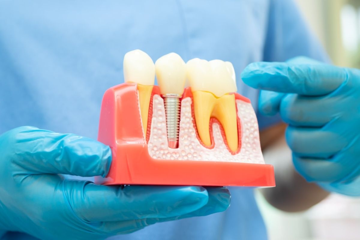 Featured image for “How Long Do Dental Implants Last?”