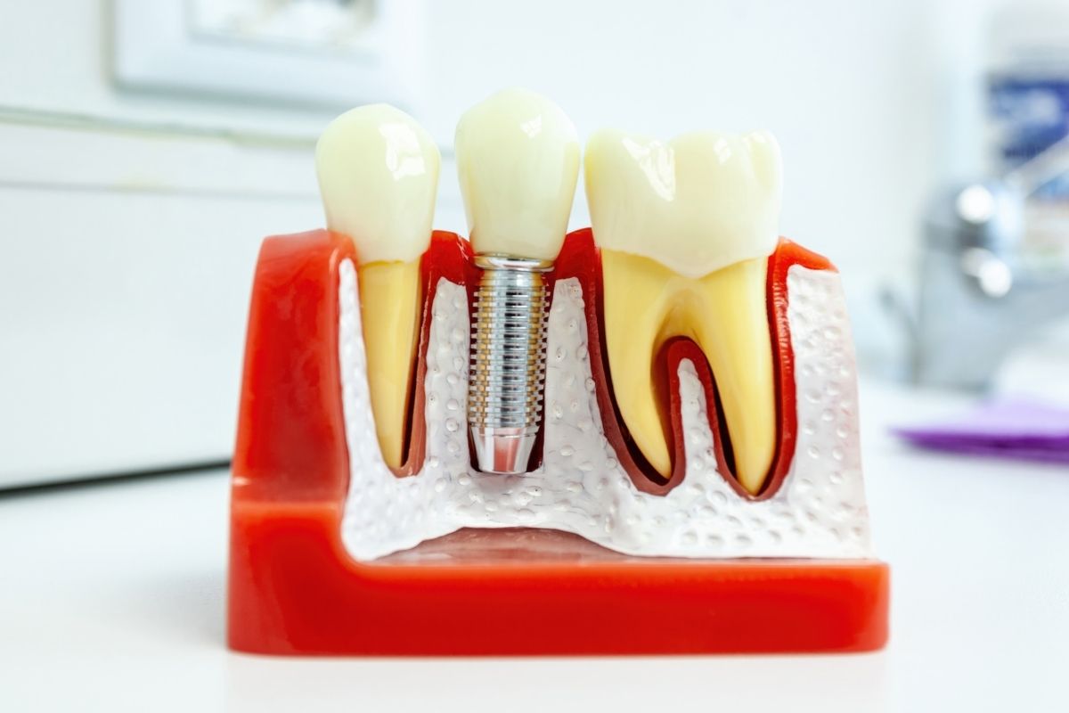 Featured image for “Single Tooth Implants: The Natural Looking Solution for Missing Teeth”