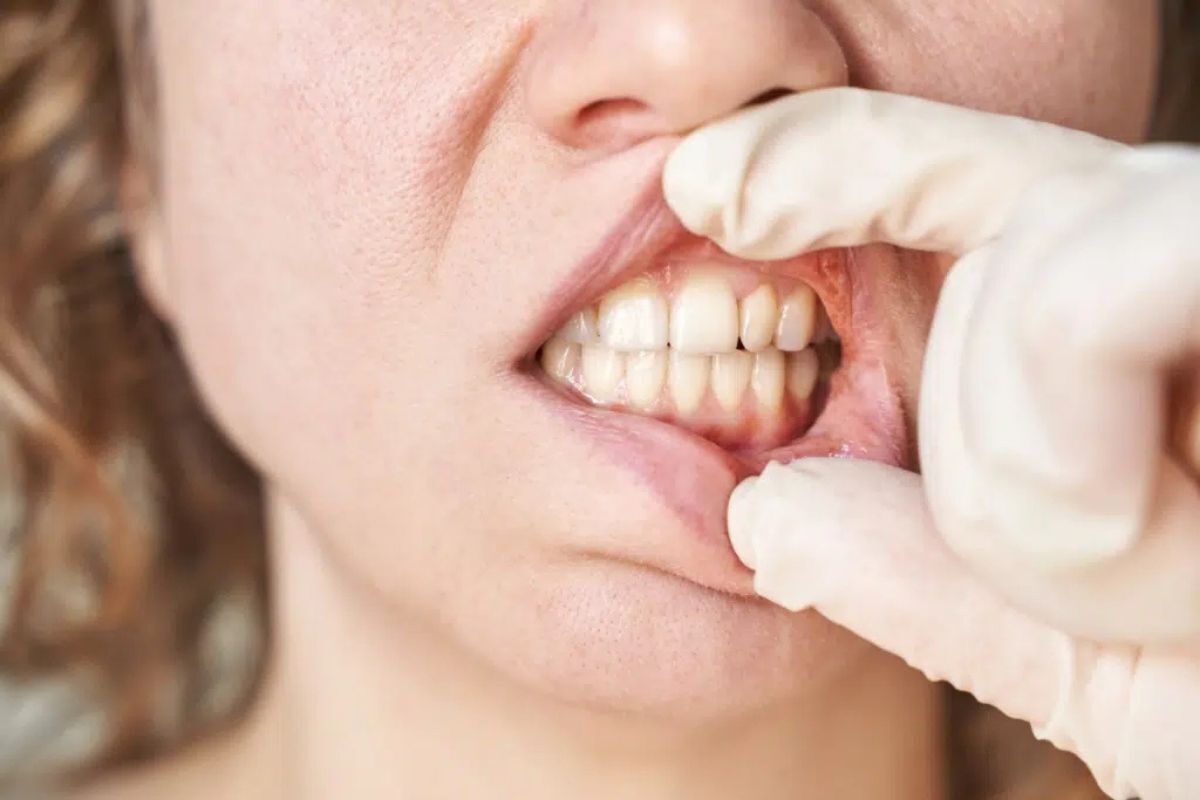 Featured image for “How Gum Surgery Can Help Save Teeth Affected by Advanced Gum Disease”