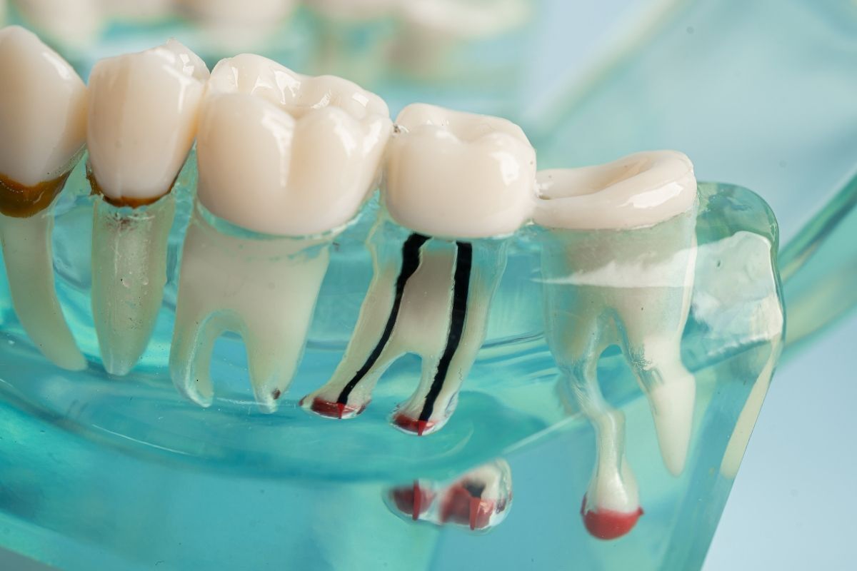 Featured image for “Can Scaling & Root Planing Save Your Teeth from Gum Disease?”
