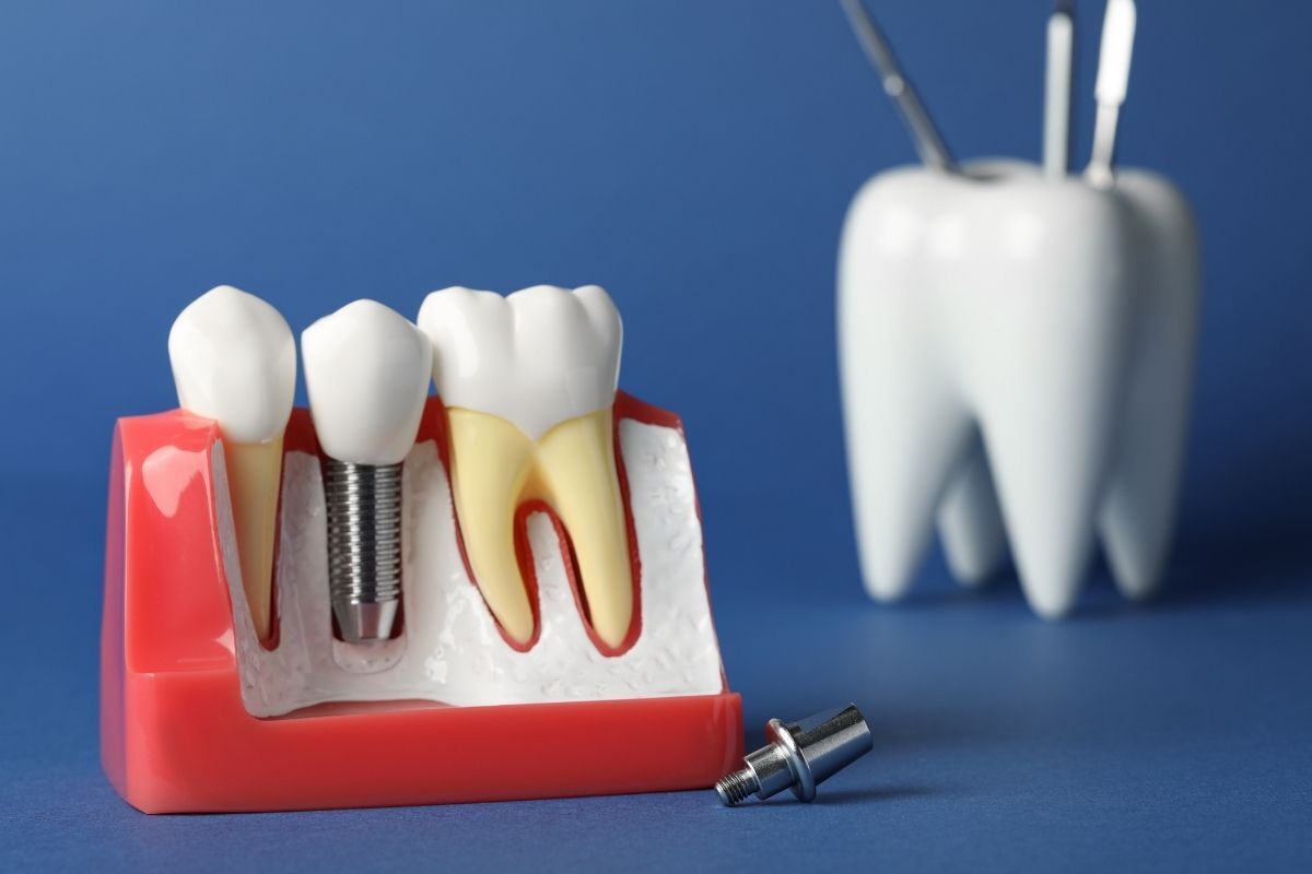 Featured image for “What Is the Best Antibiotic for a Dental Implant Infection? A Dentist’s Guide”