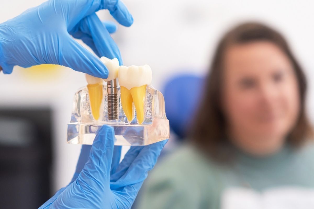 Featured image for “How Long Do Mini Dental Implants Last? What Patients Should Know”