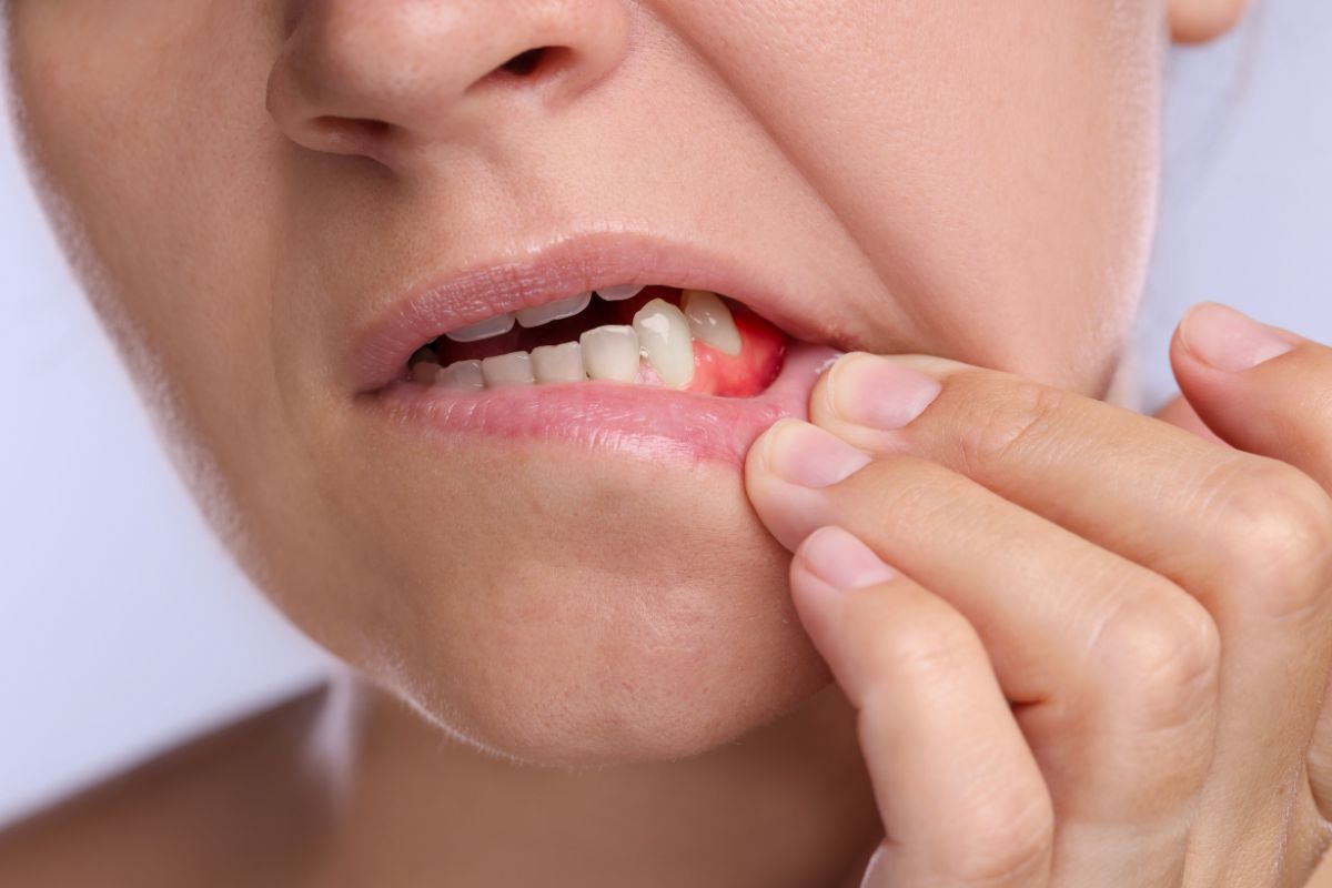 Featured image for “Sensitive Gums, Swelling, or Bleeding? Signs You Shouldn’t Ignore”